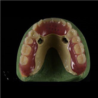 Peek Framework hammasproteesi