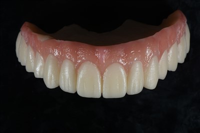 Väliaikainen akryylihartsikruunu