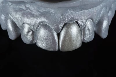 Anterior Zirkonia kruunu yhden hampaan palauttamiseen